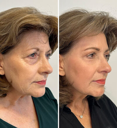 Pamela Stevenson Before & After